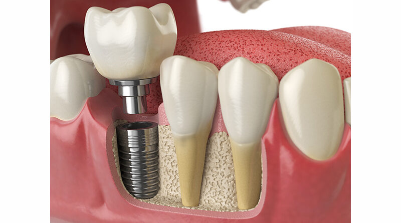 implant zębowy